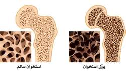 پوکی استخوان؛ نشانه ها، علائم و درمان